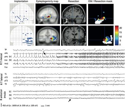 Epileptogenicity Maps of Intracerebral Fast Activities (60–100 Hz) at Seizure Onset in Epilepsy Surgery Candidates